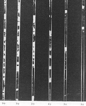 Fig. 3 Diferentes grados de aglutinacin en la prueba de tubos capilares para tripanosoma