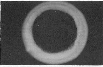 Figura 2. Inmunodifusin radial (Mancini)
