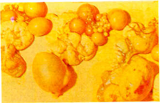 FIGURA 3. Hemorragias severas en oviducto y huevos con superposicin de cscaras