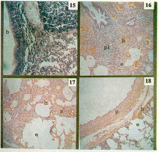 FIGURA 15. Grupo "B" se aprecia a la izquierda epitelio bronquial intacto (B) a la derecha notable hiperplasia linfocitaria peribronquial (I). H. I. 4OOX.