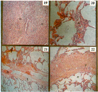 FIGURA 19. Grupo "C" severo cuadro neumnico (N), por inflamacin que compromete todas las luces alveolares. H. E. 300 X.