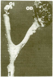 FIGURA 1.Aspecto macroscpico de cistoadenocarcinoma papilar en ovario derecho (OD) en un canino de la raza English Setter de un ao (Caso No. 5). Obsrvese ovario izquierdo de apariencia normal (01).