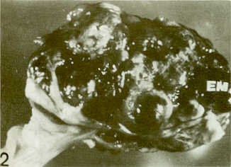 FIGURA 2.Magnifestacin de la macroscpica  del  cistoadenocarcinoma papilar observado en la Figura 1. Ntense espacios multiqusticos conteniendo liquido pardo oscuro (EM). Se indican tambin reas slidas (AS).