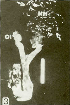FIGURA 3.Apariencia macroscpica de cistoadenocarcinoma papilar en ovario derecho (flechas), en un canino de la raza Cocker Spaniel de ocho aos (Caso No.16). Ntense amplias reas indistintas de hemorragia, necrosis (NH) y el ovario izquierdo de aspecto normal (01).