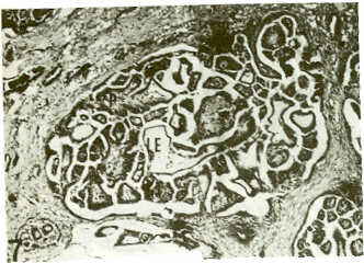 FIGURA 4.Detalle histolgico (mayor aumento) de otra zona de cistoadenocarcinoma papilar (Caso No. 5), mostrando grandes cavidades conteniendo clulas tumorales (CT), proyecciones papilares (P) y lquido eosinoflico (LE). Se aprecian cuerpos similares a los de Psammoma (CP). HE: l00x.
