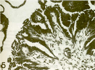 FIGURA 6.Aspecto microscpico de cistoadenocarcinoma a mayor aumento (Caso No.5). Observndose desde simple a mltiples capas de clulas epiteliales cuboidales o columnares (flechas) soportadas por tejido conectivo (TC), el cual muestra invasin de clulas neoplsicas (I). HE: 250x.