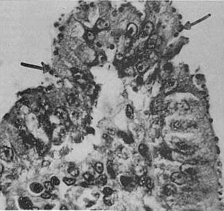 FIGURA 2 . Microvellosidades intestinales atrofiadas notndose la presencia del  Cryptosporidium. ColoracionGiemsa