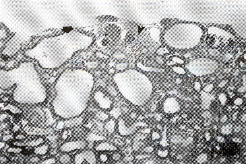 FIGURA 2. Rin de aves afectadas por el virus de BIA observndose tbulos con degeneracin hidrpica severa ( ) y necrosis aguda ( ), se aprecia la presencia de un material eosinofilico intratubular aparentemente formando uratos ( ), focos de hemorragia y congestin. H&E 1OOX.