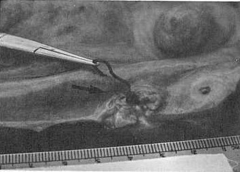 Fig. 5. Corte longitudinal mostrando los parsitos extrados del granuloma.
